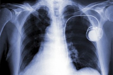 Pacemaker